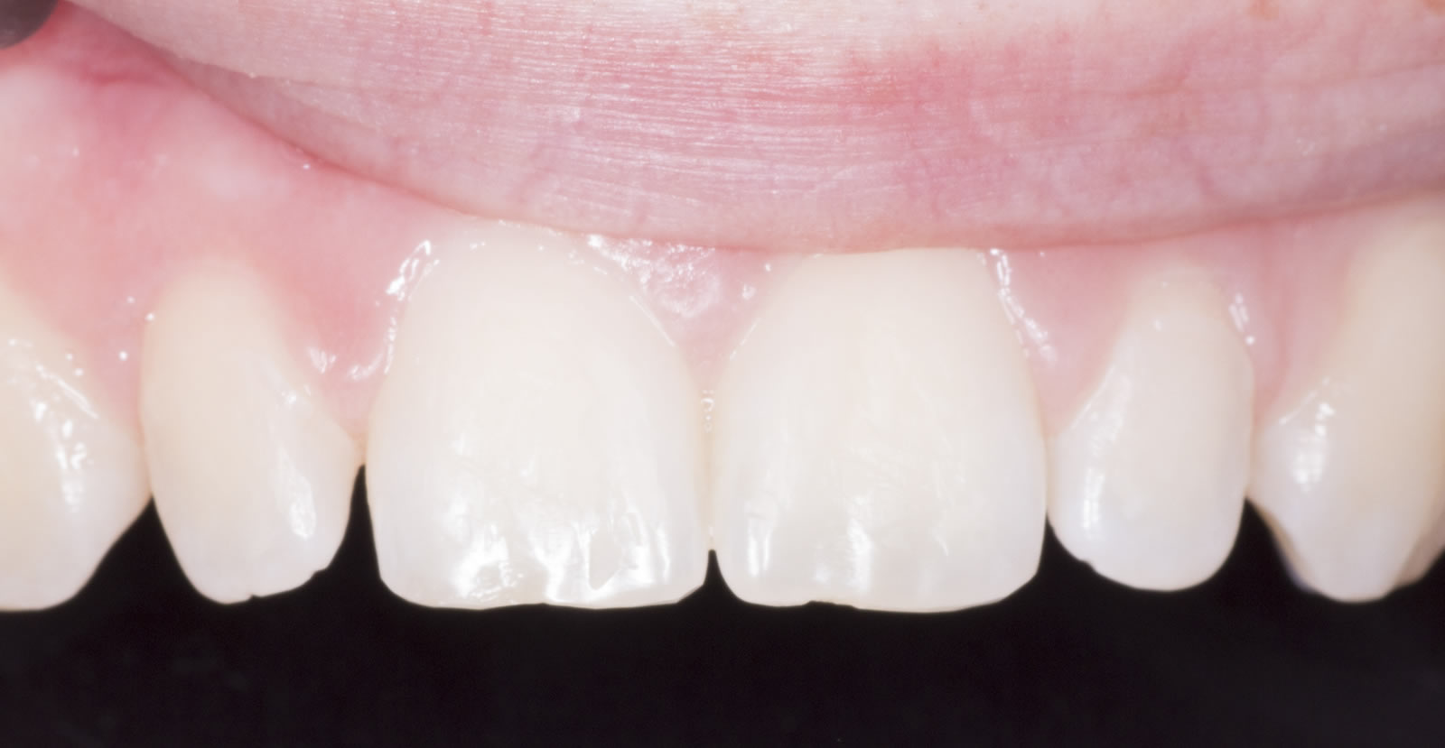 tooth whitening in donegal