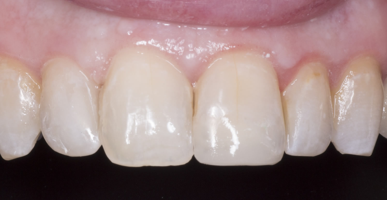 whiten your teeth in donegal