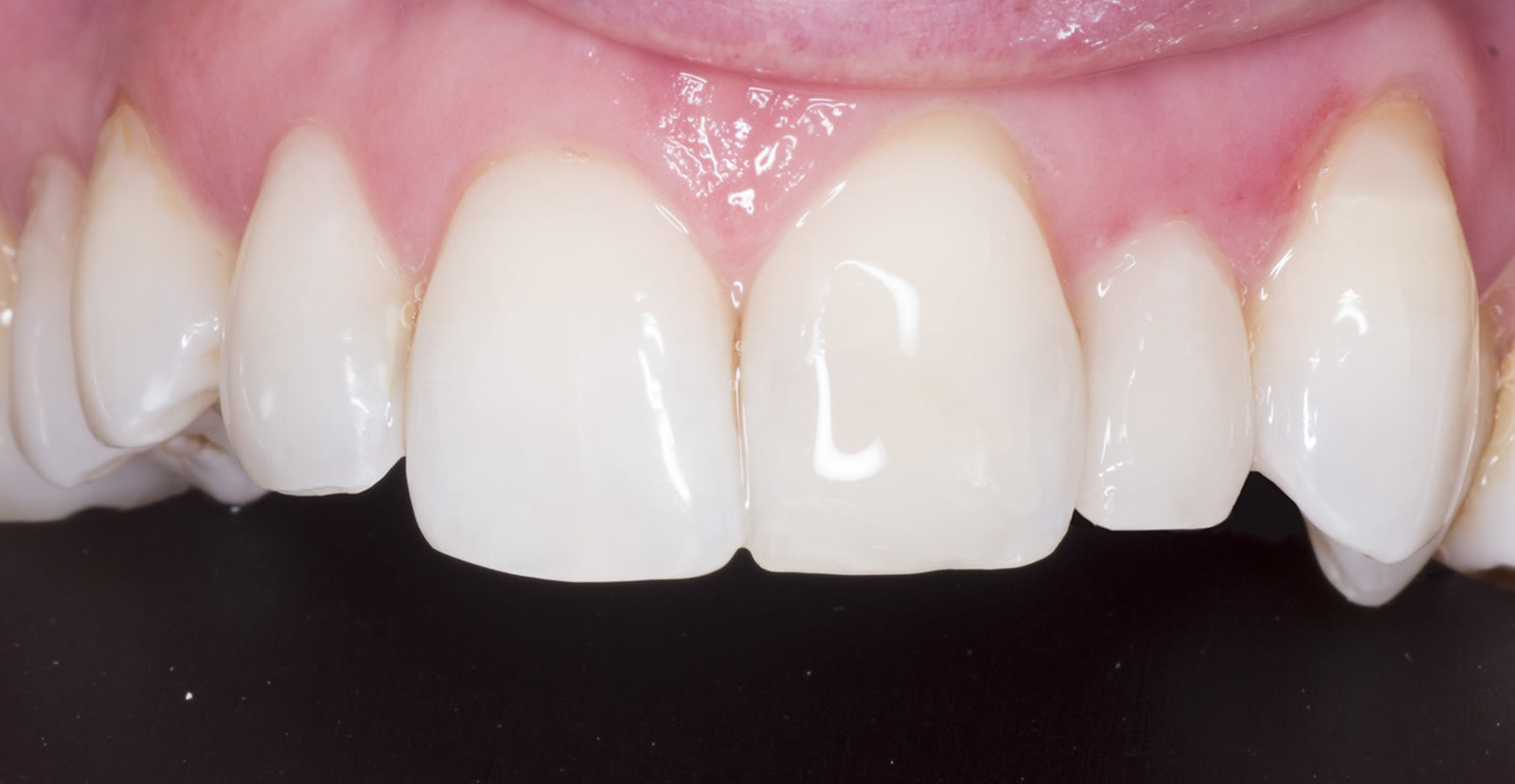 whiten your teeth in donegal